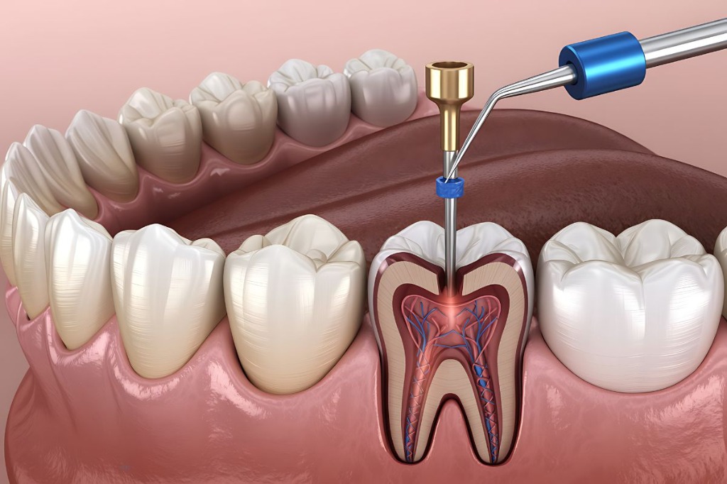 Tratamiento de Endodoncia